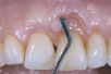 anaxGUM | Gingiva paste