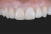 anaxGUM | Gingiva paste