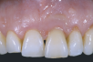 anaxGUM | Gingiva paste
